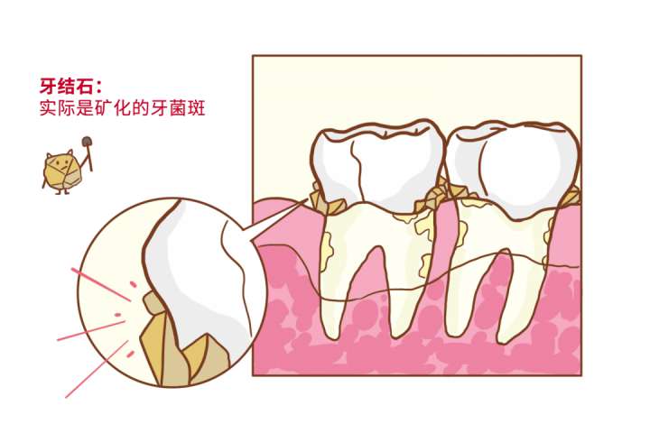 【口腔知识科普】“洗牙”到底会不会引起牙齿松动？