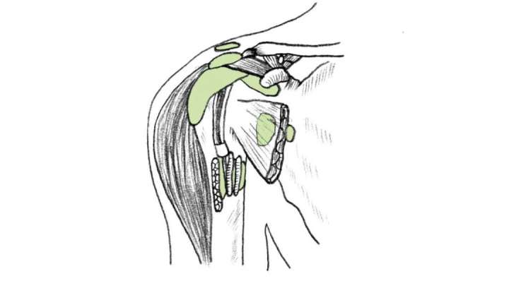 骨科科普|肩痛系列之肩袖损伤（下）——保守治疗方案