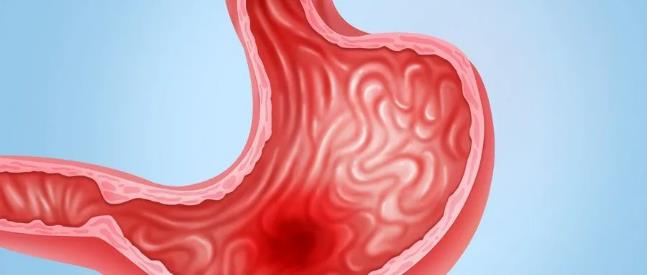 萎缩性胃炎是哪里萎缩？答案可能和你想的不一样