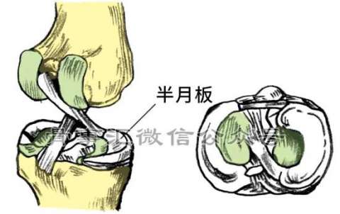 骨科科普|膝关节半月板撕裂，能做的不只是手术