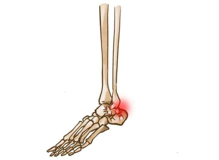 专家支招|脚后跟总是疼痛，是什么原因造成的？怎么治疗？