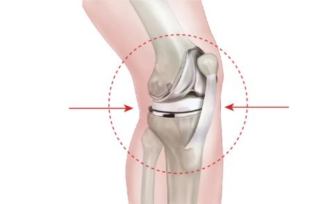 膝关节置换术前康复小常识