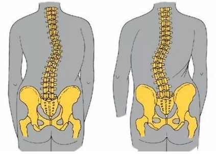 如何帮孩子早期发现脊柱侧弯，怎么治疗才正确？