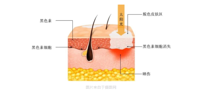 专家支招|你对白癜风了解多少？