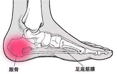 这4招，可以解决90的足跟痛，你一定要学会！
