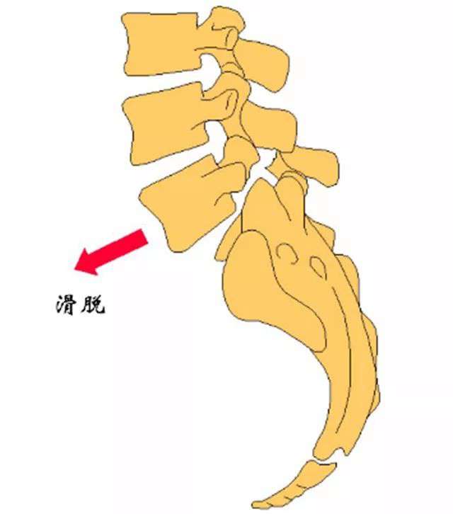 腰疼得厉害，除了腰突还可能是这个病，有几点一定要注意