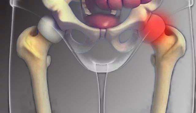 股骨头坏死不要慌，科学治疗更靠谱
