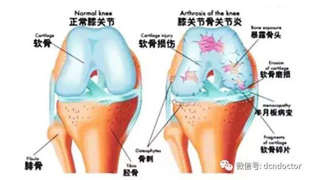 疼、肿、响，都是膝盖老化的标志，如何让关节退化慢一点，再慢一点？