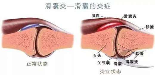 跑步后膝盖疼，最有可能的五个原因是什么？