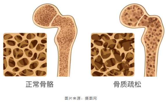 营养科普|老生常谈论“补钙”
