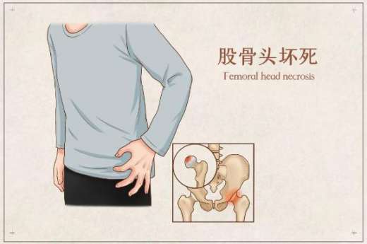 骨科科普|髋关节疼痛不一定是股骨头坏死