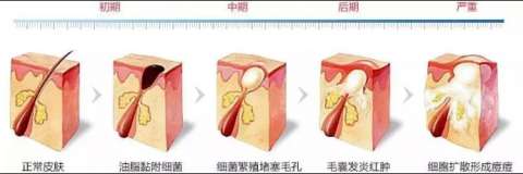 痘痘，痤疮反复发作，怎么办？