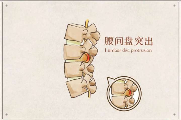 专家支招 | 久坐之后腰背经常疼，如何区分腰肌劳损还是腰椎间盘突出？