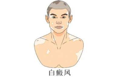专家支招|你对白癜风了解多少？