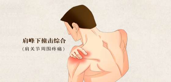 肩峰下撞击综合征，快看看你有没有