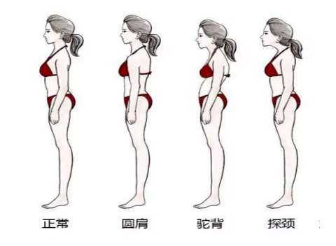 上交叉综合征：圆肩、驼背！也不怕不怕了
