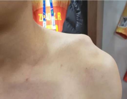 肩膀都翘起来了我是不是脱位了？看看医生怎么说！(图文)