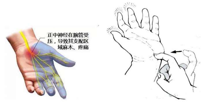 手麻―一定是得了颈椎病吗？