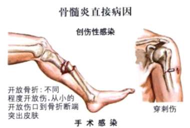 将五阿哥折磨死的附骨疽是一种什么疾病？