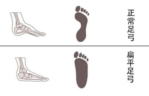 孩子脚底平，是不是扁平足？要不要治疗？