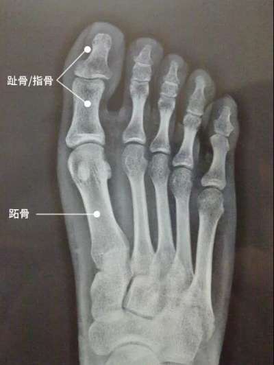跑步也能骨折，你听过吗？