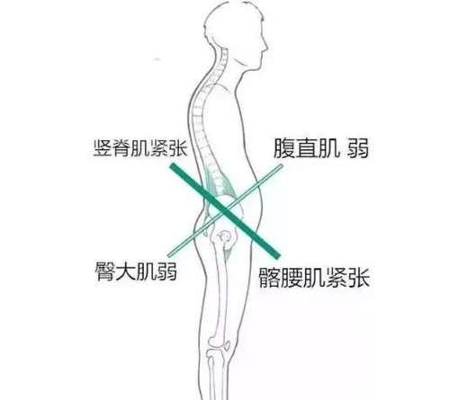 天生翘臀？请警惕下交叉综合症