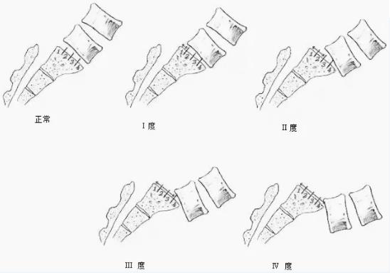 腰椎滑脱，你不可忽视的“痛”