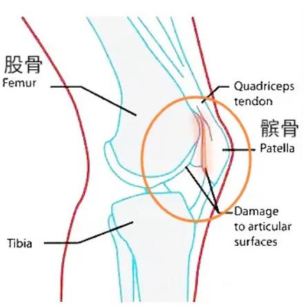 万万没想到 膝盖疼是这个原因