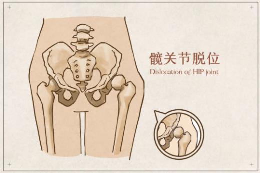 当高龄老人遇上髋关节脱位