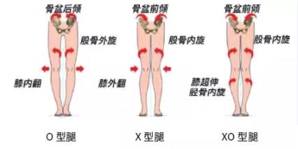 正确认识儿童“X 型腿”、“O 型腿”
