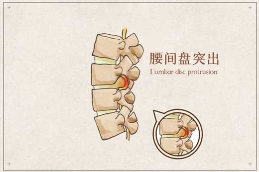 腰椎间盘突出患者最关心的几个问题