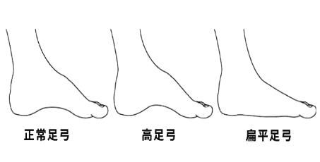 什么是高弓足?高弓足的症状和危害有哪些?
