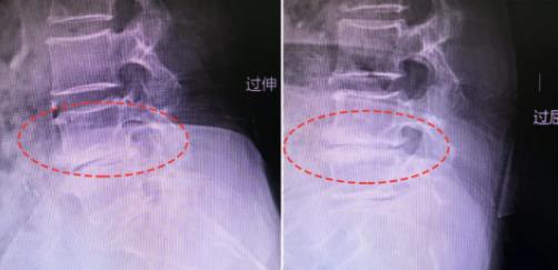 行走困难不一定是膝盖的事，打钉子也不一定是大手术