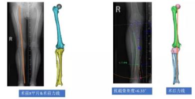 我院首次成功应用体外3D打印技术， 曲铁兵教授、郭文龙主任共同完成胫骨高位截骨手术