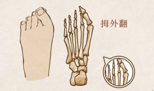 “大脚骨”就是脚骨变大了吗？