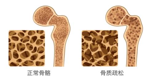 老年人骨痛该注意什么？