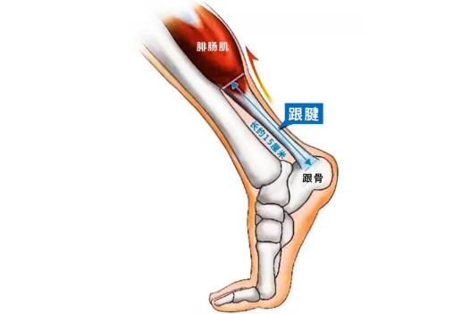 运动性跟腱断裂的原因及预防
