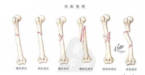“伤筋动骨100 天”，你知道为什么是100天吗？