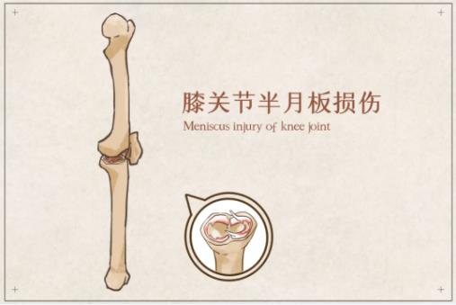 同样是做半月板切除术，为什么每个人恢复的都不一样？