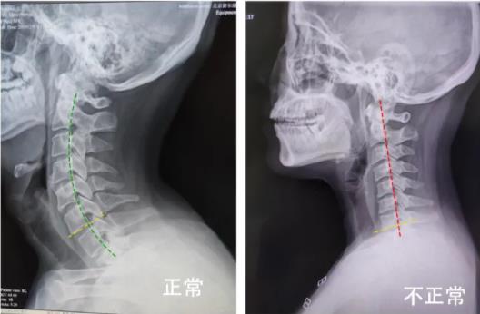 颈椎生理曲度变直怎么办？别担心你的脖子还有得救