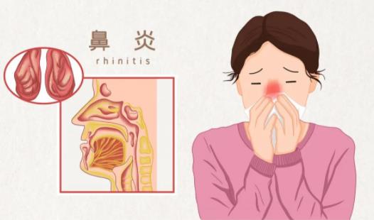 针灸治过敏性鼻炎有奇效，最真实的经验分享
