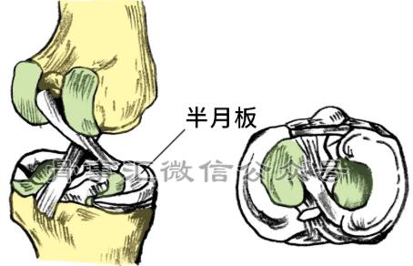 半月板损伤了，你该怎么办？