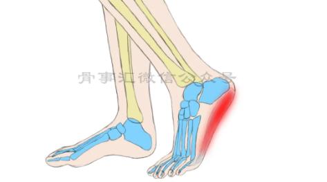 脚后跟疼，这两个原因较常见