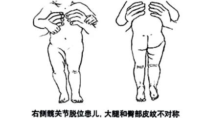 孩子是否是先天性髋关节脱位，做这3个动作就知道！