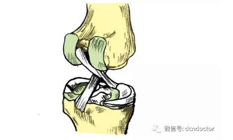 前交叉韧带损伤最常见的24个问题，这个大夫全回答了！