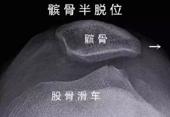 髌骨脱位，走着走着就散了，软骨都磨淡了……