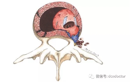 腰椎间盘突出就是水床漏水，电线漏电，治疗方式就是消炎、止疼、加固！