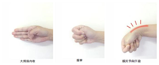 手指弹响是怎么了？【腱鞘炎患者请注意】