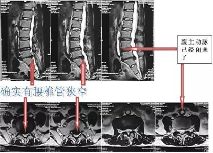 腿疼、腿麻，居然因为动脉硬化……
