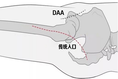90岁老太髋关节动了个“大手术”，术后当天就能走！